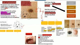 Oral nevi  Nevus HISTOPATHOLOGYjunctionalcompound and intradermalClinical features [upl. by Siduhey35]