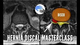 La VERDAD sobre las hernias discales [upl. by Evie]