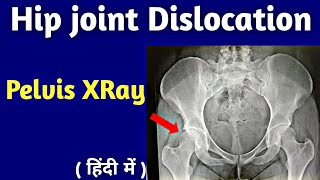 Hip joint Dislocation XRay  Pelvis XRay  कूल्हे की हड्डी का फ्रैक्चर एक्सरे  Uday X Ray [upl. by Edmonds]