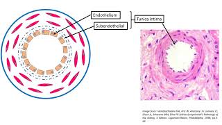 Hyaline arteriolosclerosis [upl. by Dloreh]