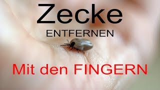 Zecke entfernen mit den FINGERN [upl. by Judenberg182]