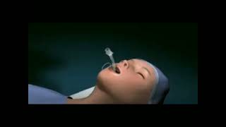 how to perform Tracheostomy tube ETT [upl. by Nyliuqcaj]