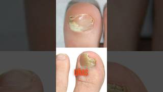 Así debes tratar los hongos en las uñas de los pies 🦶 onicomicosis uñas hongo tratamiento [upl. by Annam423]