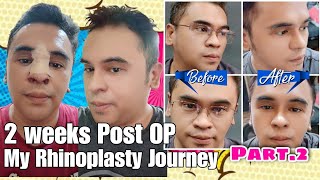 2 Weeks Post OP My Rhinoplasty Journey Part 2 by Doc Ferdinand Lacson Kosmed [upl. by Emmet]