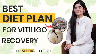 Best Diet Plan for Vitiligo Recovery  Vitiligo Patients Should Eat These Foods  Vitiligo Treatment [upl. by Zoi]