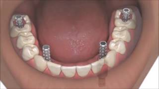 AllOn4 Dental Implants Coventry Best Same Day Full Whole Mouth Teeth Implants At Verum Dentists [upl. by Trudey]