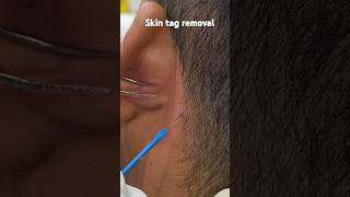 Skin tag removal skintag skintagremoval viralvideo viralshorts [upl. by Melesa]