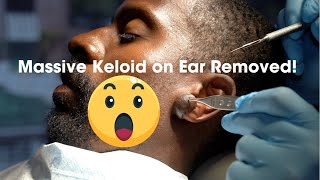 Watch As I Remove a Stubborn Ear Keloid – StepbyStep [upl. by Ellis]