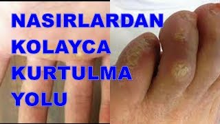 El Ayak Nasırlarından Kolayca Kurtulabileceğinizi BİLİYOR MUYDUNUZ [upl. by Lemmueu]