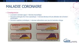 3 17 3 Syndrome coronarien aigu  physiopathologie [upl. by Floyd]