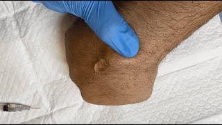 Drainage of a Ganglion Cyst [upl. by Rehttam]