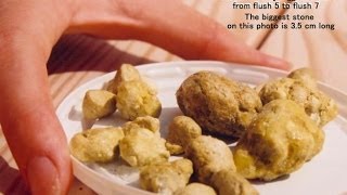 Liver Detoxify Gall Stone Cleanse Removal Of Gallstones Gallstone Attacks [upl. by Akenot]