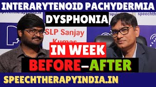 BeforeAfter Dysphonia  Interarytenoid Pachydermia Sulcus Vocalis Within A Week  SLPSanjayKumar [upl. by Scevour]