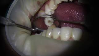 Root canal treatment RCT on lower premolar tooth  1 min video [upl. by Norean]