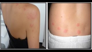 What Bit Me Spot These 12 Bug Bites [upl. by Atiuqad]