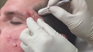 Super Satisfying Blackhead Removal [upl. by Natascha]