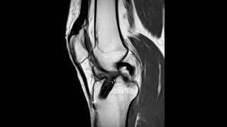 Arthrofibrosis cyclops lesion in knee after ACL repair [upl. by Zaid]