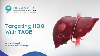 HCC Liver Cancer Understanding Treatment and TACE in English [upl. by Irving]