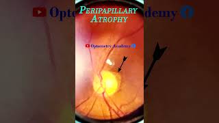 Peripapillary atrophy  Smartphone Fundus Videography  Fundus Photography  Short Video 64 [upl. by Sluiter248]