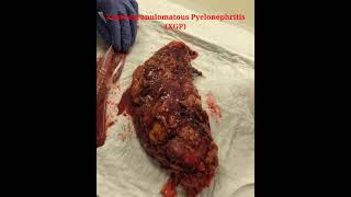 Xanthogranulomatous Pyelonephritis XGP [upl. by Dusa]