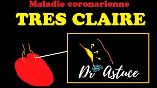 La Maladie Coronaire Expliquée TRES CLAIREMENT 24  Rencontre Ces 4 Patients   Dr Astuce [upl. by Dorin616]