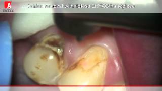 CARIES REMOVAL Fotona Lightwalker ErYAG laser [upl. by Lennahc]