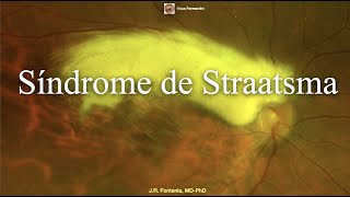 Síndrome de Straatsma Miopía Ambliopía y Mielinizacion de capa de fibras nerviosas retinianas [upl. by Padget]