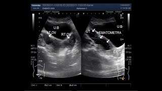 Hematometra in 25 years old unmarried lady [upl. by Pincus]