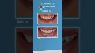 Opalescence™ Boost™ and Opalescence Go™  Case Study [upl. by Evin]