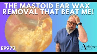 THE MASTOID EAR WAX REMOVAL THAT BEAT ME  EP972 [upl. by Soalokin]