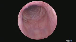 epiglottic chondroma in a dog [upl. by Todhunter]