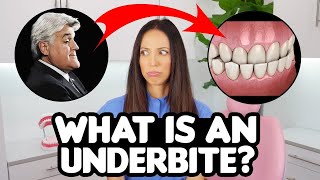 Underbite Correction EXPLAINED causes amp treatments [upl. by Marder250]