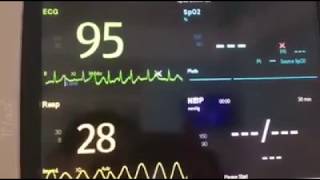 BradyTachy syndrome in Sinus sick syndrome [upl. by Yzmar133]