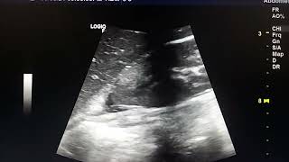 pyelonephritis ultrasound findings [upl. by Aenil637]