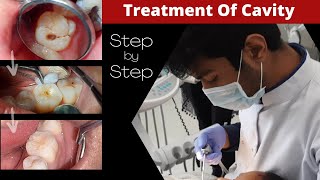 Composite Filling Step by Step  Cavity In Tooth  How To Fill Decayed Tooth  Dr Sunil Kumar [upl. by Aili111]