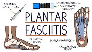 Understanding Plantar Fasciitis [upl. by Pudendas10]