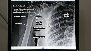 shoulder anatomy x ray x ray anatomy scapula clavicle Glenohumeral Joint Acromioclavicular Joints [upl. by Nyrek]