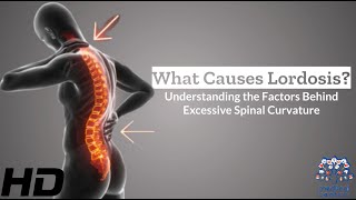 Unlocking Lordosis The Factors Behind Excessive Spinal Curvature [upl. by Anura]