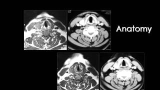 Radiology  Imaging of Larynx  Head and Neck [upl. by Tterab]