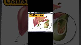 Gallstones  Cholelithiasis  Cholilithiasis  Epigastrium Pain on Ultrasound [upl. by Stag808]