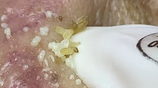 Acne treatment for Spa Linh Mun 2024 49 [upl. by Llenrad]