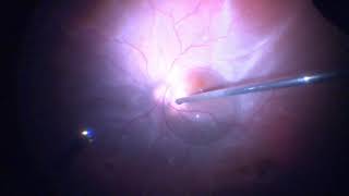 Surgery Vitrectomy for Retinal Detachment Assortment of Cases [upl. by Sherwynd26]