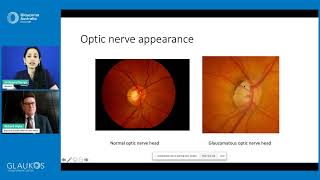 Treatment and management of different types of glaucoma with Dr Aparna Raniga mp4 [upl. by Anaeerb681]