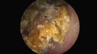 Satisfying Ear Wax Removal With Dokter Tht [upl. by Aneelak311]