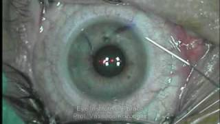 Refractive Surgery LASIK [upl. by Cammi]