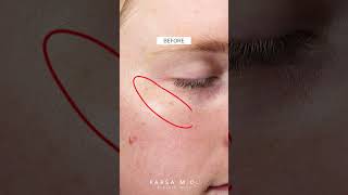 Before and After IPL Laser LUMECCA Kami Parsa MD  PARSA MD skincare [upl. by Erdried]