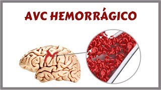 Acidente Vascular Cerebral Hemorrágico  AVCH [upl. by Mile]