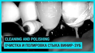 Cleaning and polishing transition between tooth and veneer Очистка и полировка стыка винирзуб [upl. by Hanselka594]