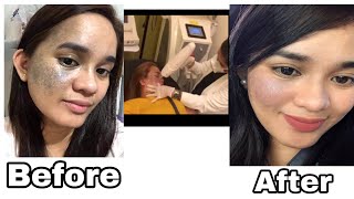 My birthmark removal journey [upl. by Somerset]