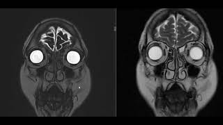 49 year female with left orbital pain [upl. by Elockcin]